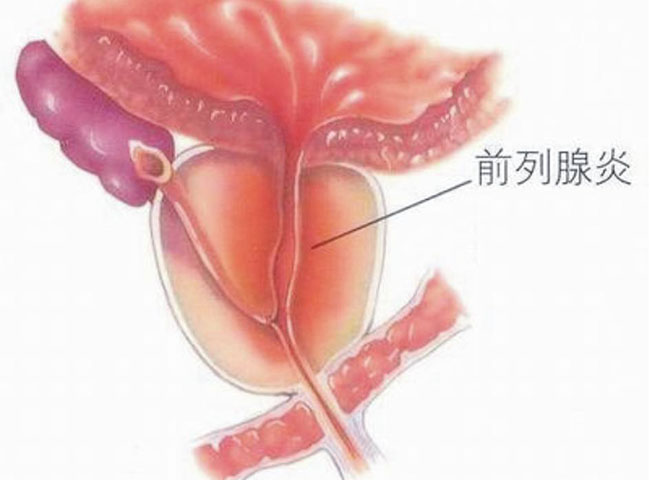 前列腺结石没办法碎石吗 前列腺结石唯有这个这个方法治