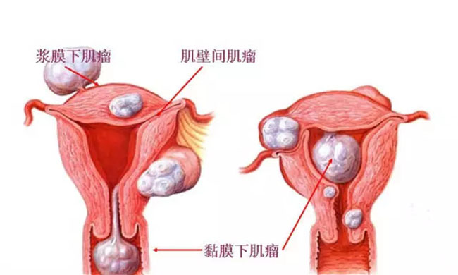 子宫囊肿严重吗 会影响孕育和月经期不调真假进来便知晓