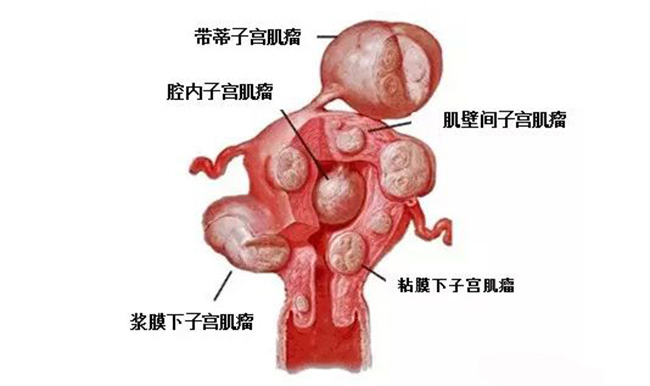 子宫切除后有什么影响 OMG~没有子宫将无法受孕是么