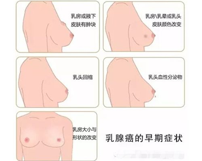 乳腺癌早期图片 4招快速自测乳腺癌这些症状要警惕