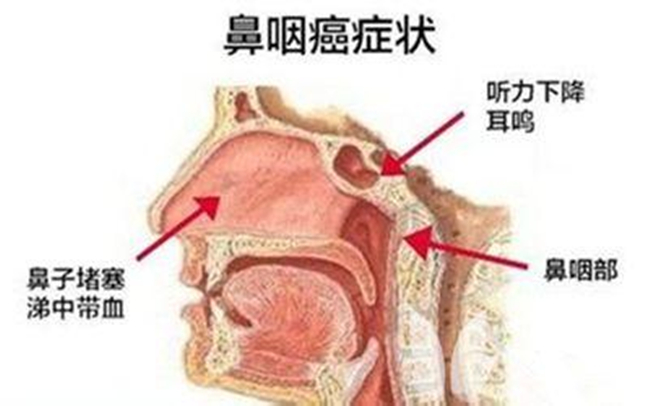 鼻咽癌的早期症状 得了鼻咽癌的早期信号千万要警惕