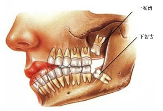 智齿牙龈肿痛怎么办 智齿一定要拔吗 拔一个智齿多少钱